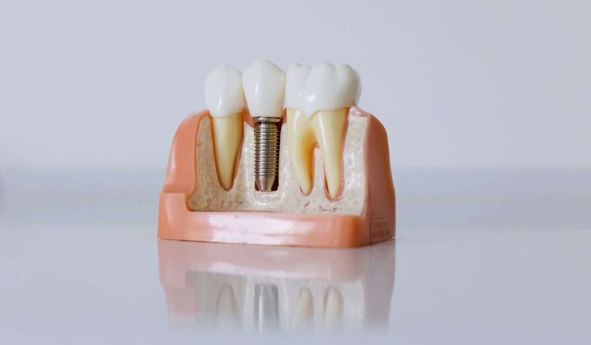 Does Medicaid Cover Dental Implants? Rules & Eligibility