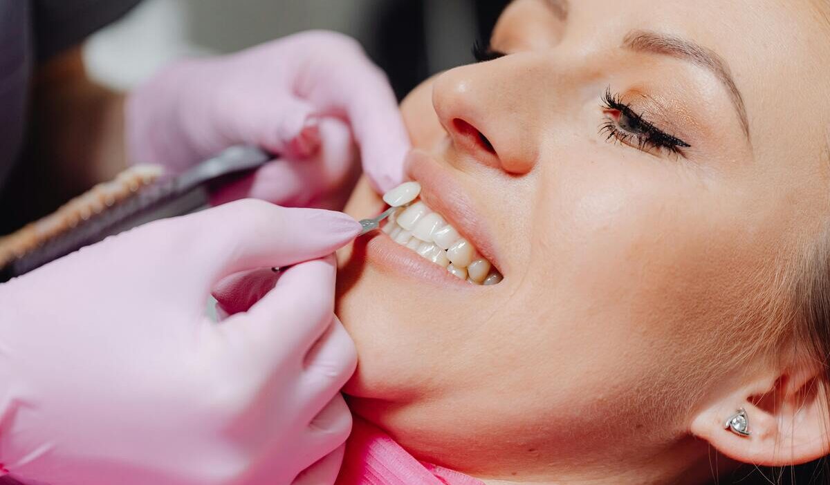 how-long-do-veneers-last-on-front-teeth