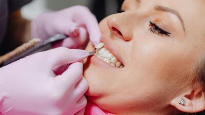 how-long-do-veneers-last-on-front-teeth