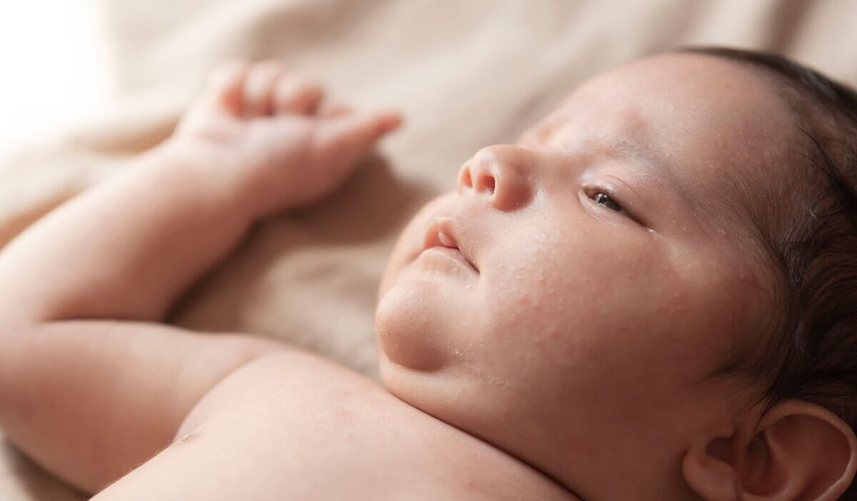 how-to-get-rid-of-baby-acne