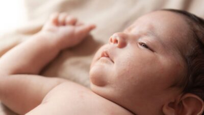 how-to-get-rid-of-baby-acne