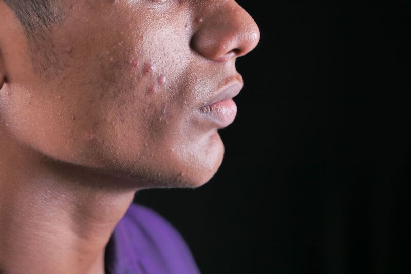 how-to-get-rid-of-razor-bumps-overnight
